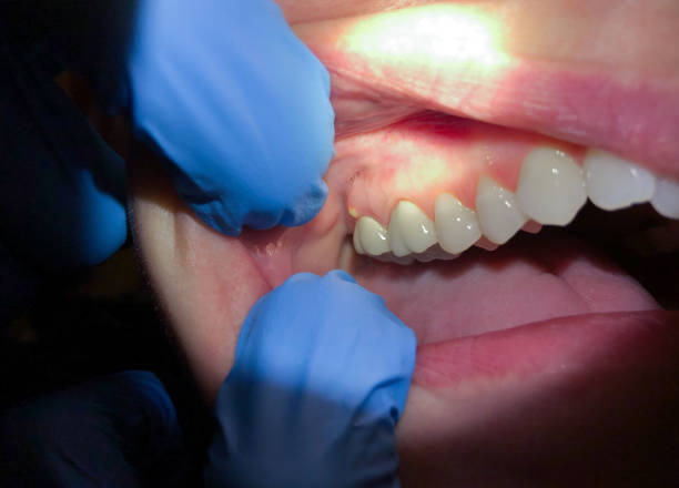 Best Dentist for Tooth Abscess  in Pineville, NC